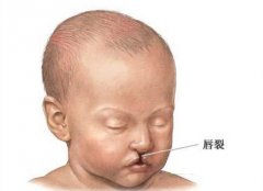 胎儿唇腭裂的超声诊断医学信息论文