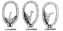 医学临床论文发表浅析前置胎盘的观察